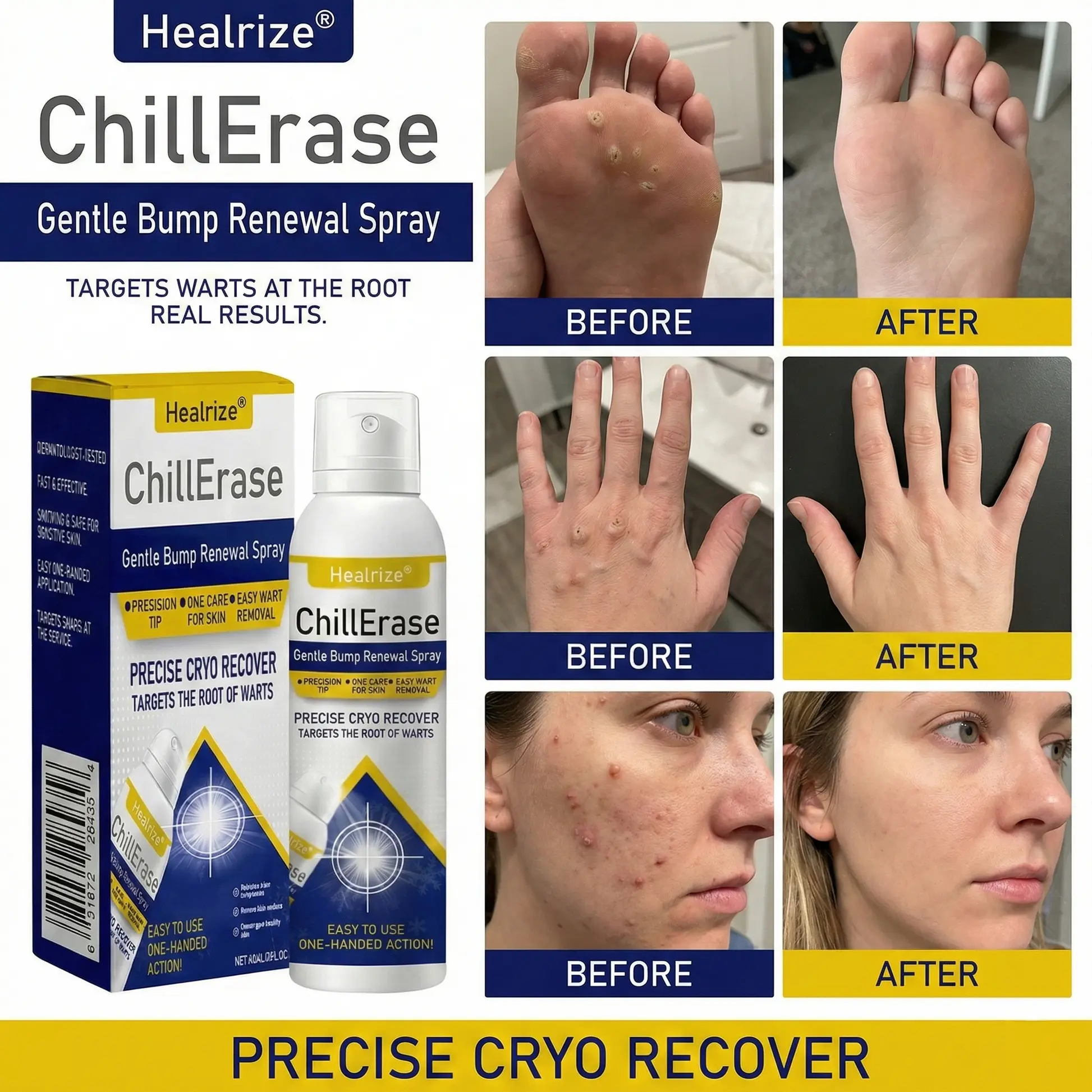 ❄️𝙎𝙥𝙚𝙘𝙞𝙖𝙡 𝙋𝙧𝙤𝙢𝙤𝙩𝙞𝙤𝙣 | Healrize®ChillErase Gentle Bump Renewal Spray ❄️