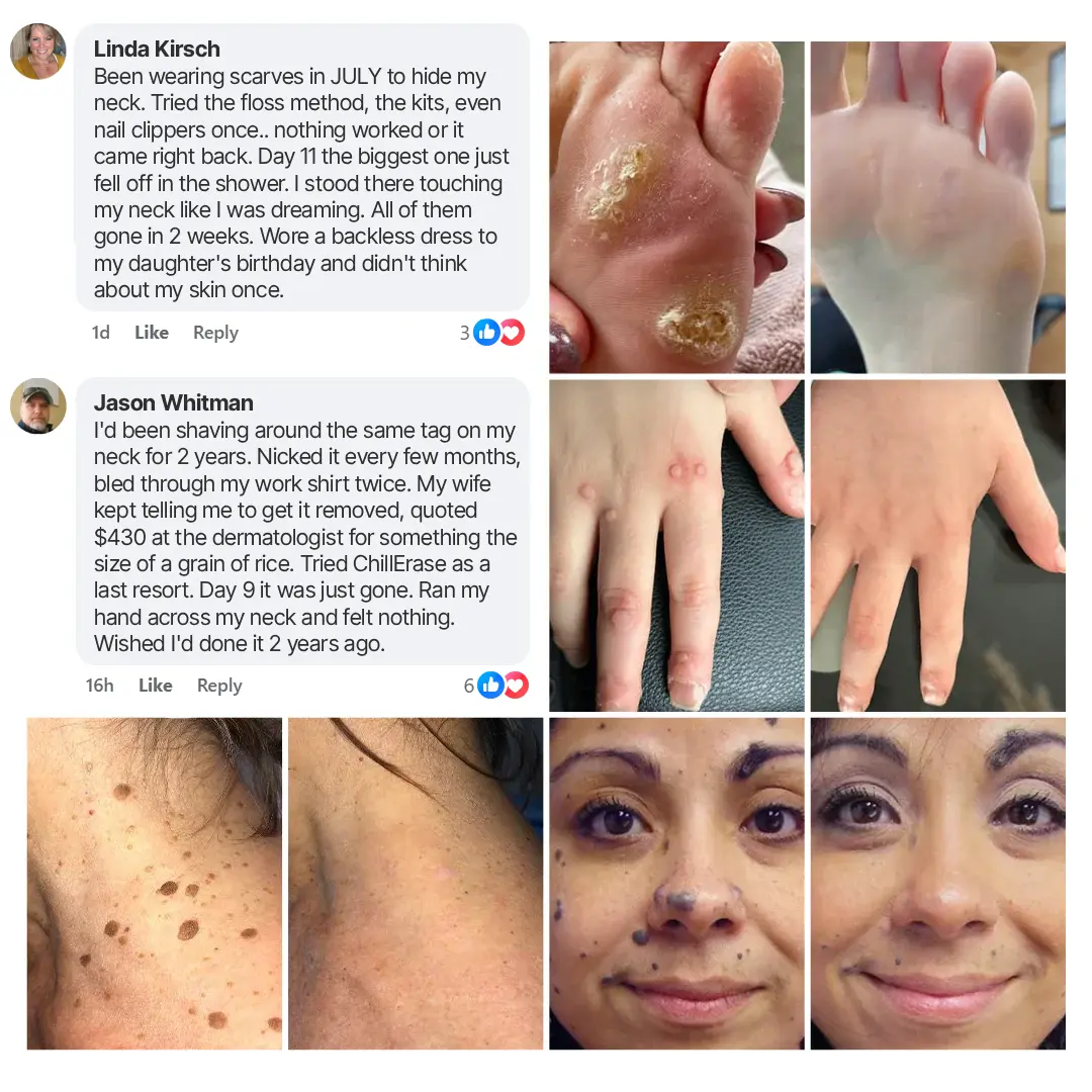 ChillErase Precision Skin Tag & Wart Removal Spray