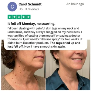 ChillErase Precision Skin Tag & Wart Removal Spray