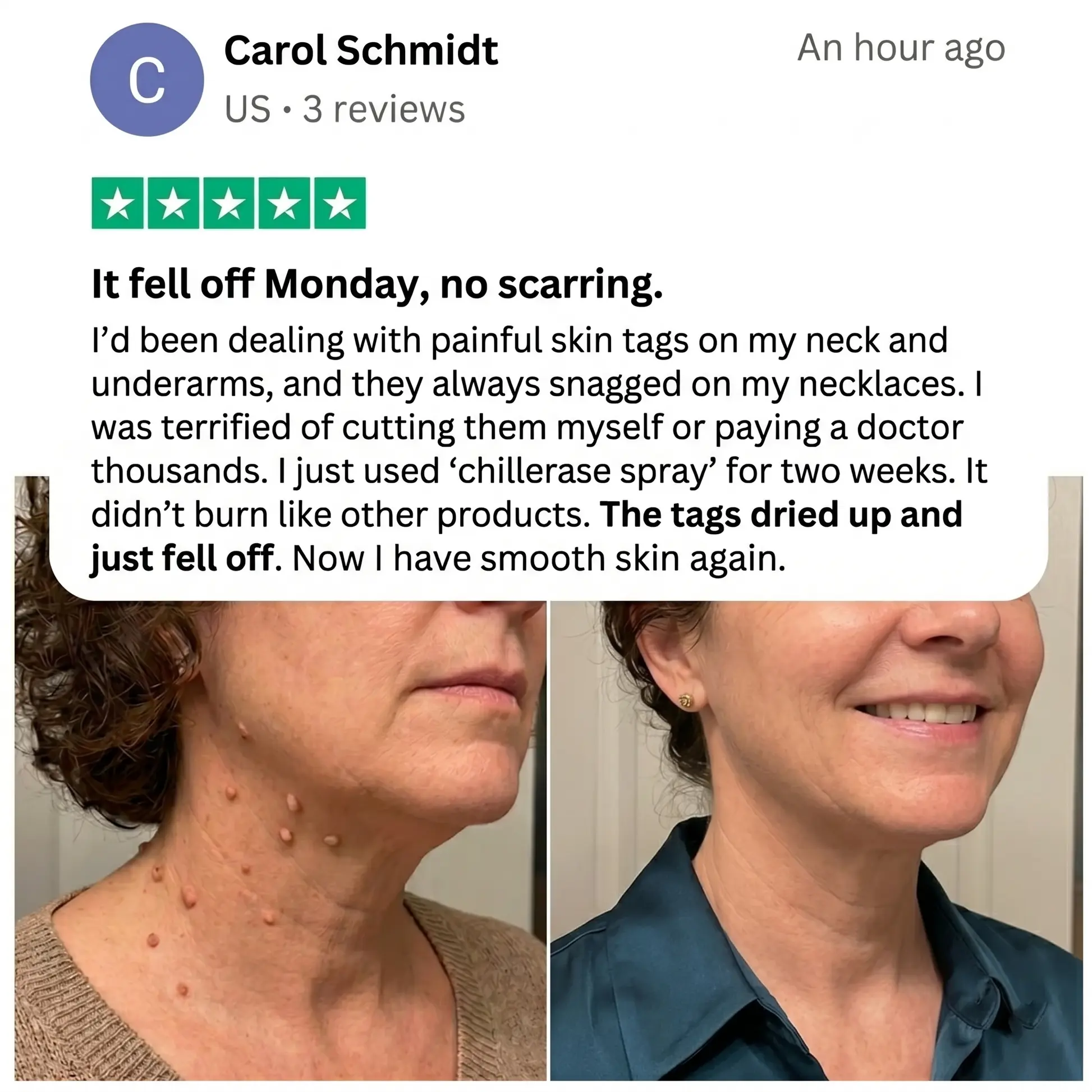 ChillErase Precision Skin Tag & Wart Removal Spray